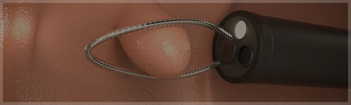 大腸カメラ検査と同時に日帰りでの大腸ポリープ切除が可能