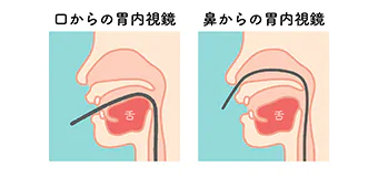 胃カメラは鼻と口からお選びいただけます